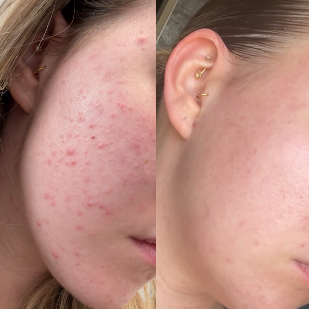 Erster Vorher-Nachher-Vergleich einer Kundin aus dem Skinconcept-Studio: zwei seitliche Aufnahmen der Wangenpartie