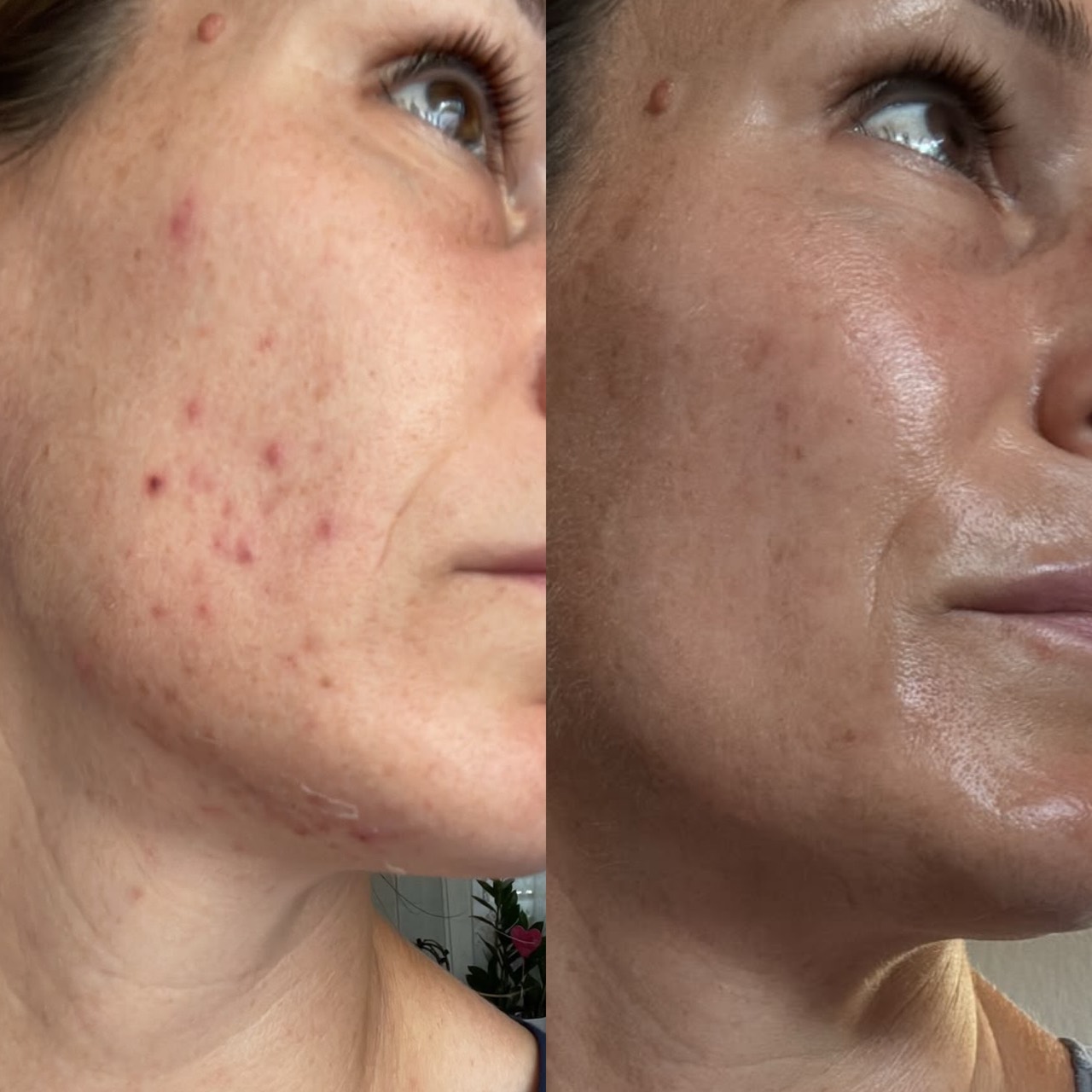Zweiter Vorher-Nachher-Vergleich einer Kundin aus dem Skinconcept-Studio: zwei seitliche Aufnahmen von Wange und Kinn