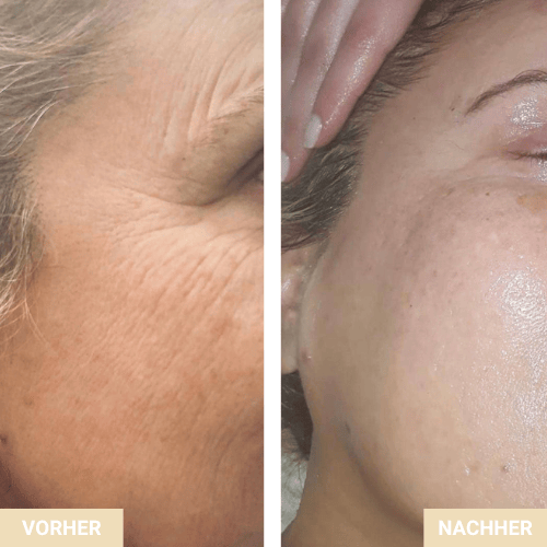 Vorher Nachher - Hautalterung