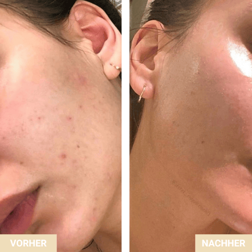 Vorher Nachher - Unreine Haut