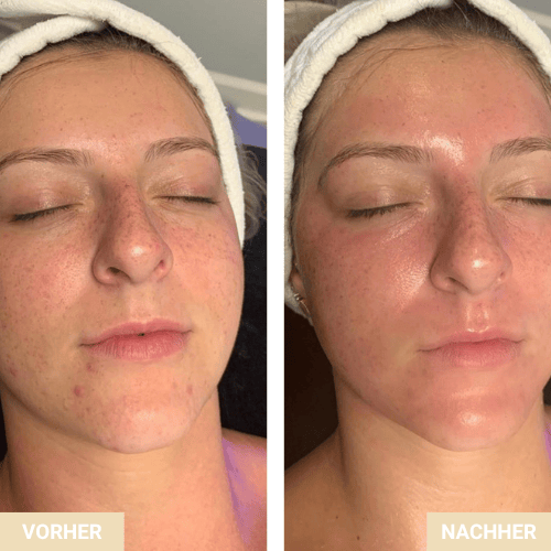 Vorher Nachher - Behandlungsergebnis